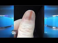 Video thumbnail for Melanoma on Your Nail?