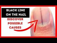 Video thumbnail for What causes vertical Dark lines on the nails? ➞【Discover Vertical black lines on fingernails causes】