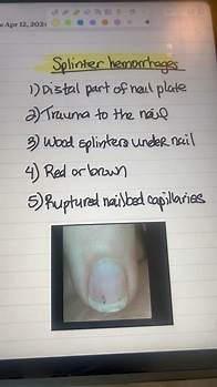 Video thumbnail for Splinter Hemorrhages of Nails #pathophysiology #medical #nails