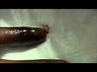 Video thumbnail for Finger Nail Hematoma Trephination