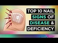 Video thumbnail for 10 NAIL SIGNS of HEALTH PROBLEMS (and Nutritional Deficiencies)