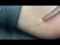 Video thumbnail for Satisfying Splinter removal