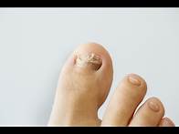 Video thumbnail for How to prevent and treat nail fungus
