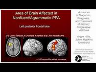 Video thumbnail for Argye Hillis: Advances in Diagnosis, Prognosis, and Treatment of Primary Progressive Aphasia