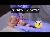 Video thumbnail for Successful Management of Painful Subungual Hematoma