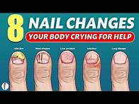 Video thumbnail for Nail signs of Disease | Nail pitting | Finger clubbing | Signs of anemia | Terry's nails