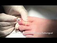 Video thumbnail for Nail Biopsy to Rule out melanoma under the nail