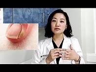 Video thumbnail for What is PARONYCHIA? It's a nail infection! | Solve Paronychia with Julia Ro, PA-C