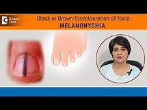 Video thumbnail for Black lines in nails| Streaks on Nail|Melanonychia Causes & Treatment-Dr.Rasya Dixit|Doctors' Circle